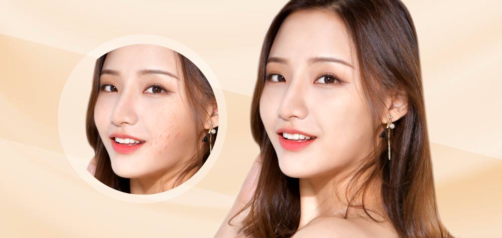 Kyo_website banner ACNE
