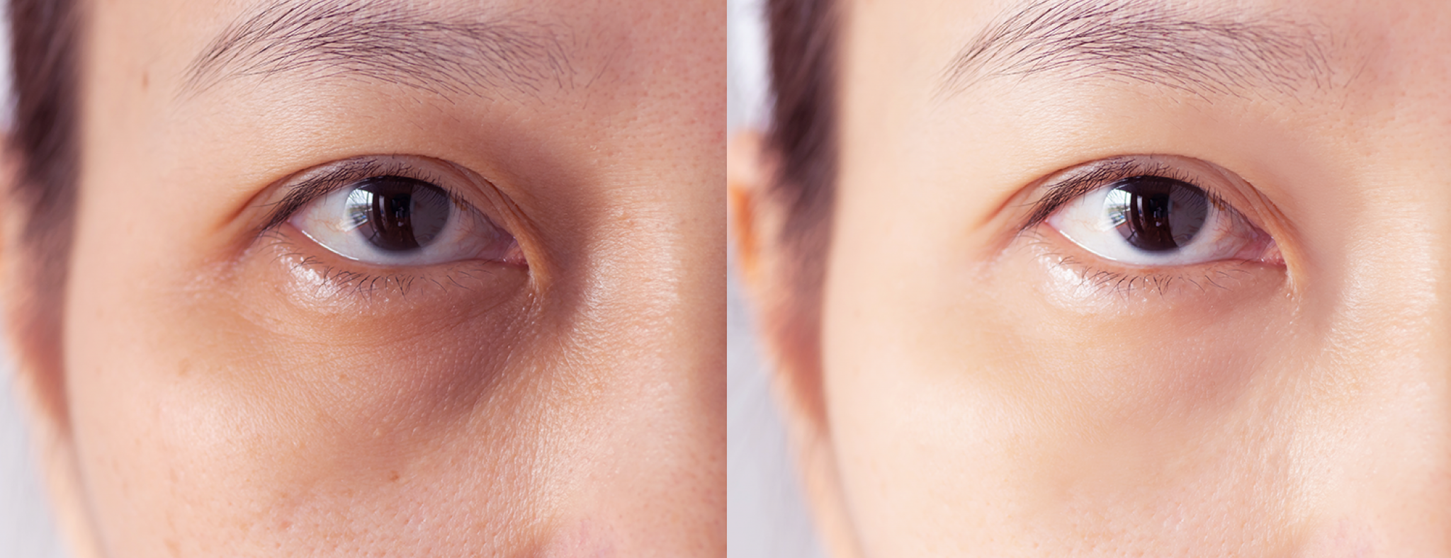 Dark Eye Circle Dr.Kyo Clinic